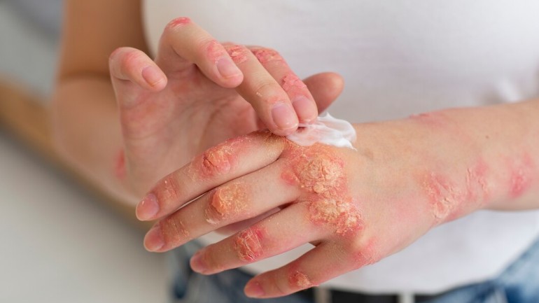 Co może pomóc w łagodzeniu objawów atopowego zapalenia skóry?