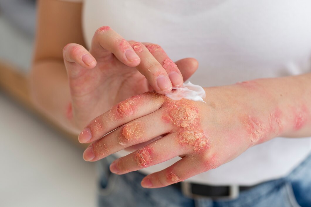 Co może pomóc w łagodzeniu objawów atopowego zapalenia skóry?